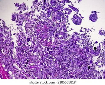 Spinal Tumor Biopsy Showing Psammomatous Meningioma. Psammoma Bodies.