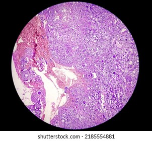 Spinal Tumor Biopsy Showing Psammomatous Meningioma. Psammoma Bodies.