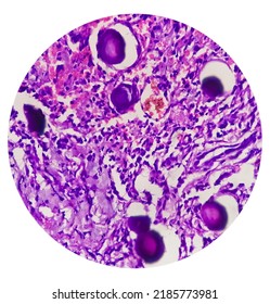 Spinal Tumor Biopsy Showing Psammomatous Meningioma. Psammoma Bodies.