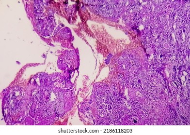 Spinal Tumor Biopsy Showing Psammomatous Meningioma. Psammoma Bodies.