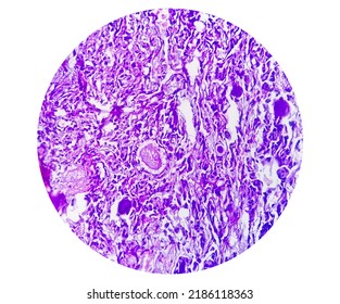 Spinal Tumor Biopsy Showing Psammomatous Meningioma. Psammoma Bodies.