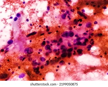 Spindle Cell Sarcoma: Cytological Study Of Intra Abdominal Mass, Positive Malignant Cells. Pleomorphic Undifferentiated Sarcoma, Malignant Fibrous Histiocytoma.