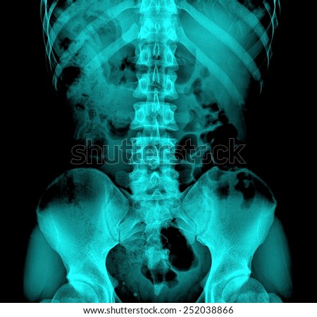 spine and pelvis of a human body on x-ray