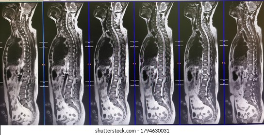 MRI​ Whole​ Spine, T2 Sagittal​ Plane.​ Mild  Compression  Fracture​ At​ L1