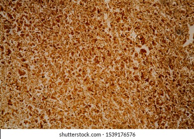 Spirocheteen Of Syphilis Liver Tissue Under The Microscope 200x