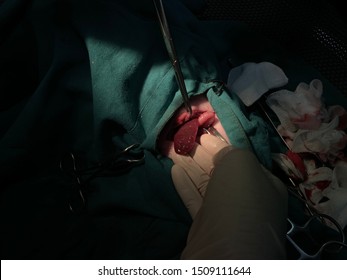 Spleen Surgery By A Medical Team For Education .