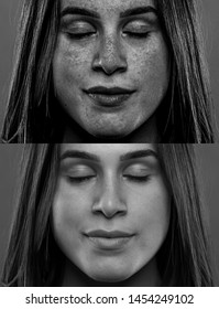 A Split Screen View Showing The Before And After Effects Of Sun Damage To The Beautiful Face Of A Young Caucasian Millennial Girl. Dangers Of Sun Exposure.