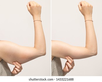 A split screen of a woman pinching the skin beneath her arm. Showing the before and after results of brachioplasty surgery, also called an arm lift. - Shutterstock ID 1433221688