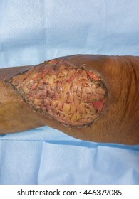 Split Skin Graft Post Operative Wound.