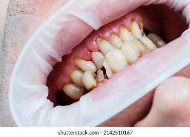 1,128 Poor dental Images, Stock Photos & Vectors | Shutterstock