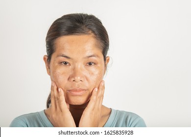 Spot Melasma Dark And Freckles  Facial Treatment On Face Asian Woman. And Skin Problem