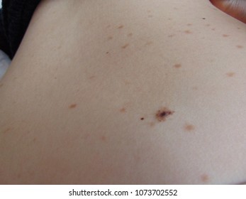 Spots And Nevus On The Skin