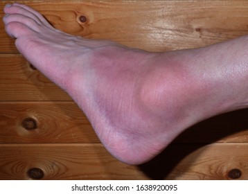 Sprained Ankle With Bruising And Swelling.