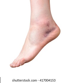 Sprained Ankle  Isolated On White