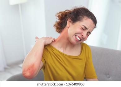 Spreading Rash. Young Lady In Pain Looking Awfully Sick Suffering From A Spreading Skin Rash Affecting Her Neck