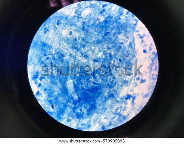 Sputum Afb Stain Afb Positive Stock Photo 570905893 | Shutterstock