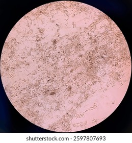Sputum analysis under microscope showing numerous septate branching hyphae with acute angles, consistent with the morphology of Aspergillus Spp. with plenty pus cells. Candida