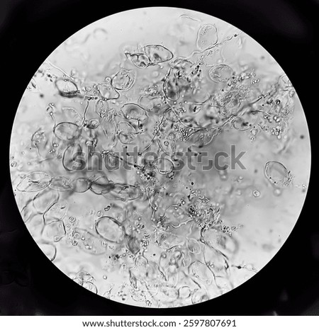 Sputum analysis under microscope showing numerous septate branching hyphae with acute angles, consistent with the morphology of Aspergillus Spp. with plenty pus cells. Candida