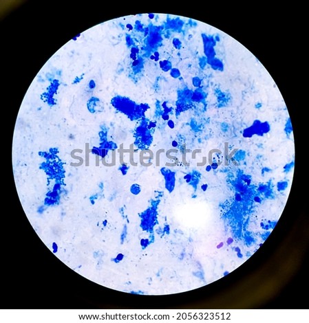 Sputum smear AFB, Acid Fast Bacillus stain microscopic show no gram negative rods shape bacteria but few gram positive staphylococcus aureus bacteria are present.