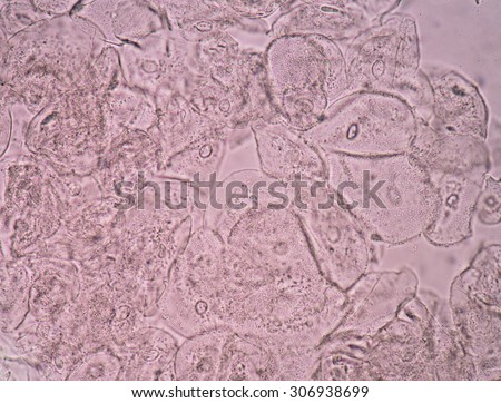 squamous cell