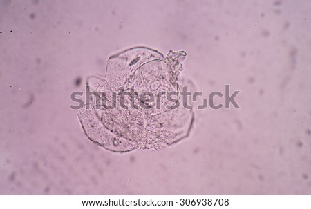 squamous cell