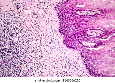 Squamous cell carcinoma, light micrograph, photo under microscope