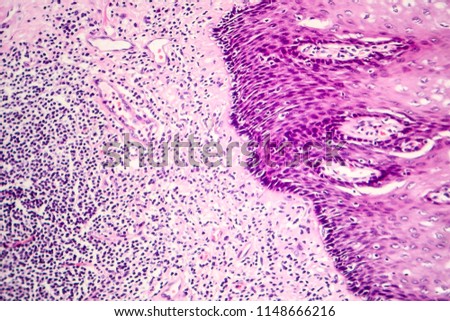 Squamous cell carcinoma, light micrograph, photo under microscope