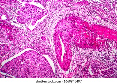 Squamous Cell Carcinoma Uterus Light Micrograph Stock Photo 1669943497 ...