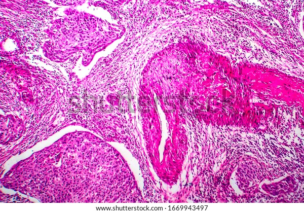 Squamous Cell Carcinoma Uterus Light Micrograph Stock Photo 1669943497 ...