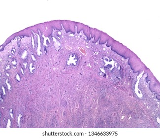 The Squamous Metaplasia Of The Cervix Is A Replacement Of The Surface Columnar Epithelium By A Nonkeratinized Stratified Squamous Epithelium. Under The Epithelium, There Are Endocervical Mucous Glands