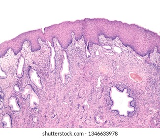 The Squamous Metaplasia Of The Cervix Is A Replacement Of The Surface Columnar Epithelium By A Nonkeratinized Stratified Squamous Epithelium. Under The Epithelium, There Are Endocervical Mucous Glands