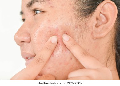 Squeezing Acne And Pressing Acne.