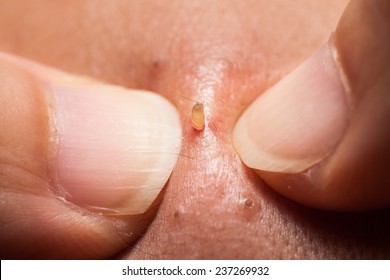 Knackköpfe aus der Nase eines Teenagers mit Fingernägeln quetschen