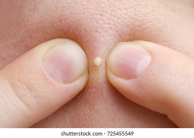 Squeezing Pimple Macro