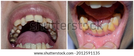 Stacked or overlapping teeth of Asian man. Also called crowded teeth. Closeup view.