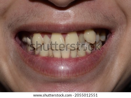 Stacked or overlapping teeth with yellow stain of Asian man. Also called crowded teeth.