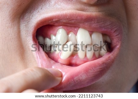 Stacked or overlapping white teeth of Asian man. Also called crowded teeth.