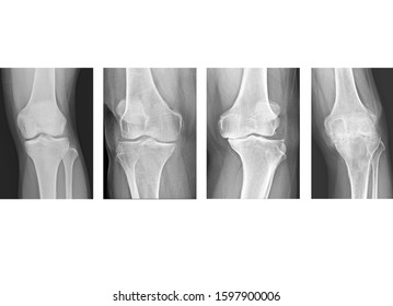 Stage of Osteoarthritis (OA) knee severe . film x-ray view of knee narrowing of joint space.Medical image with copy space.