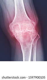 Stage Of Osteoarthritis (OA) Knee Severe . Film X-ray View Of Knee Narrowing Of Joint Space.Medical Image With Copy Space.