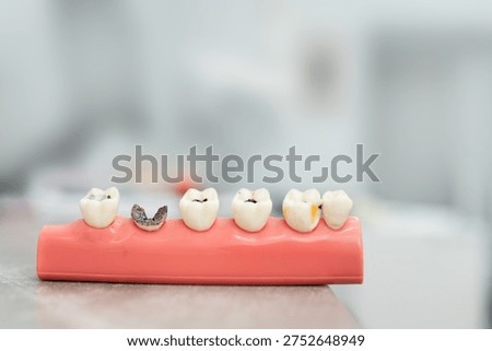 Stages of dental caries and pulpitis development on an anatomical model of a human tooth, educational material for dentists