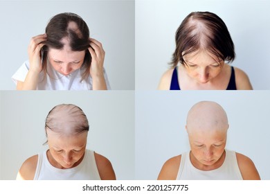 Stages Of Female Head Baldness During Autoimmune Alopecia. Baldness During Chemotherapy For Cancer