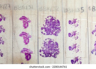 Stained Tissue Biopsy On Glass Slides In Pathology Laboratory