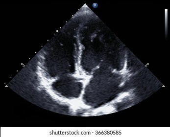  Standard transthoracic two-dimensional echocardiography in a patient with hypertension