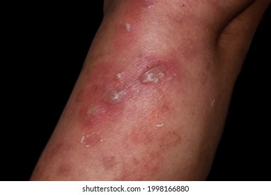 streptococcus skin