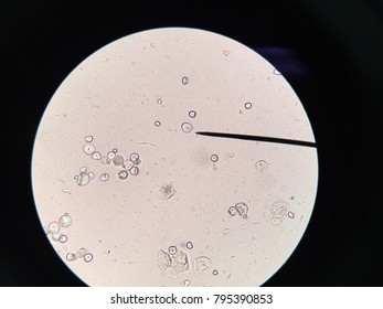 Starch Granule From Urine In Human