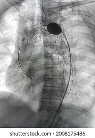 Stent graft balloon catheter was inflated after stent  graft deployed at descending aorta during Thoracic endovascular aortic repair (TEVAR).
