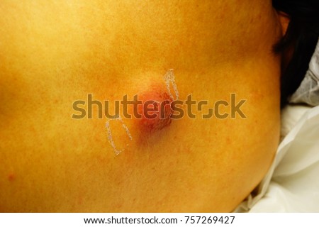 Step by step procedure of saucerization of back carbuncle with diathermy