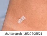 Sterile wound closure  strip used on cut after laparoscopy on woman