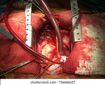 Sternotomy In Cardiac Surgery With Cardiopulmonary Bypass