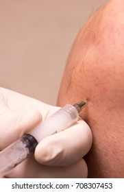 Steroid Injection Into Knee With Arthritis